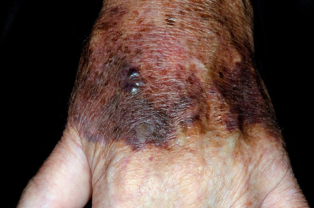 Hand bruising in warfarin patient