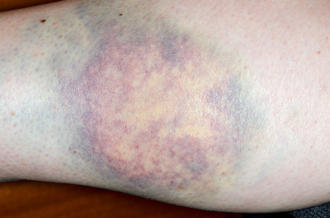 Bruise on the leg