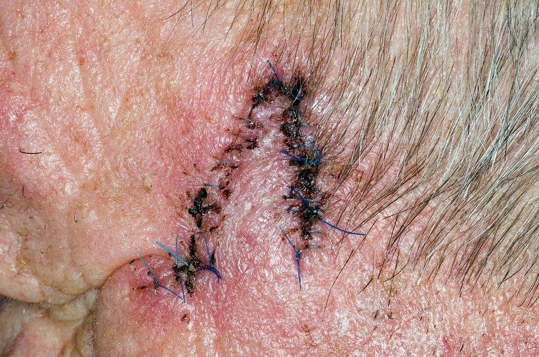 Scar after skin cancer removal