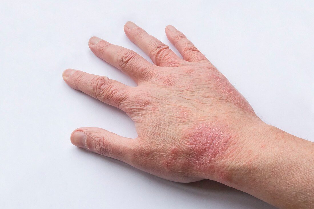 Atopic Eczema - right hand - 53 year old
