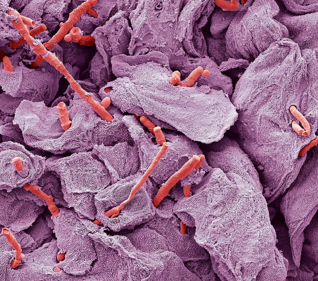 Thrush infection of the tongue,SEM