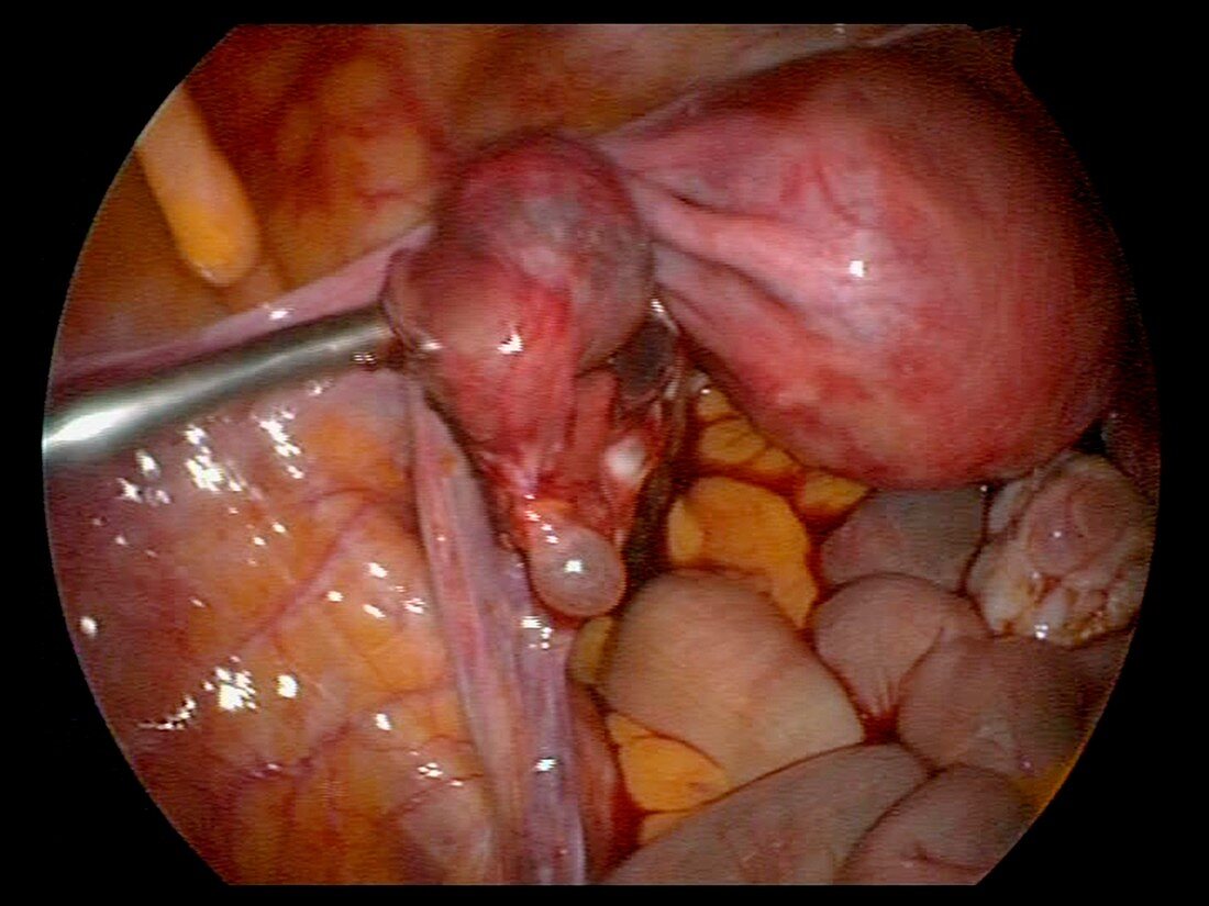 Fimbrial cyst,endoscope view