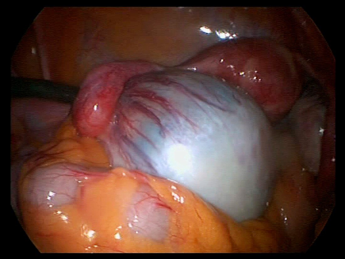 Ovarian cyst,endoscope view