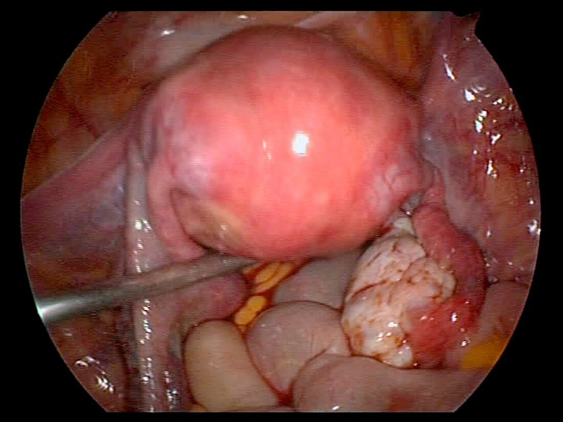 Uterus,endoscope view