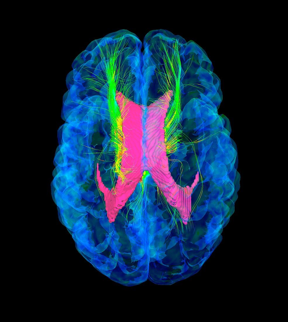 Brain fibres,DTI MRI scan