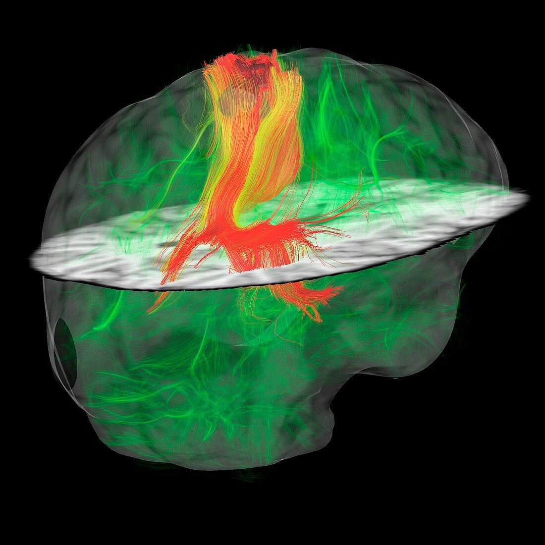 Glioblastoma brain tumour,DTI MRI scan
