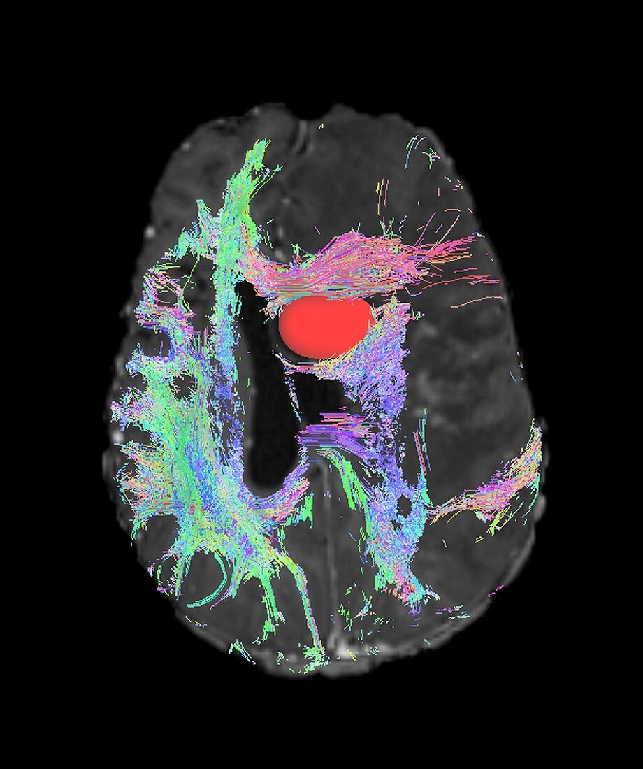 Brain tumour,DTI MRI scan