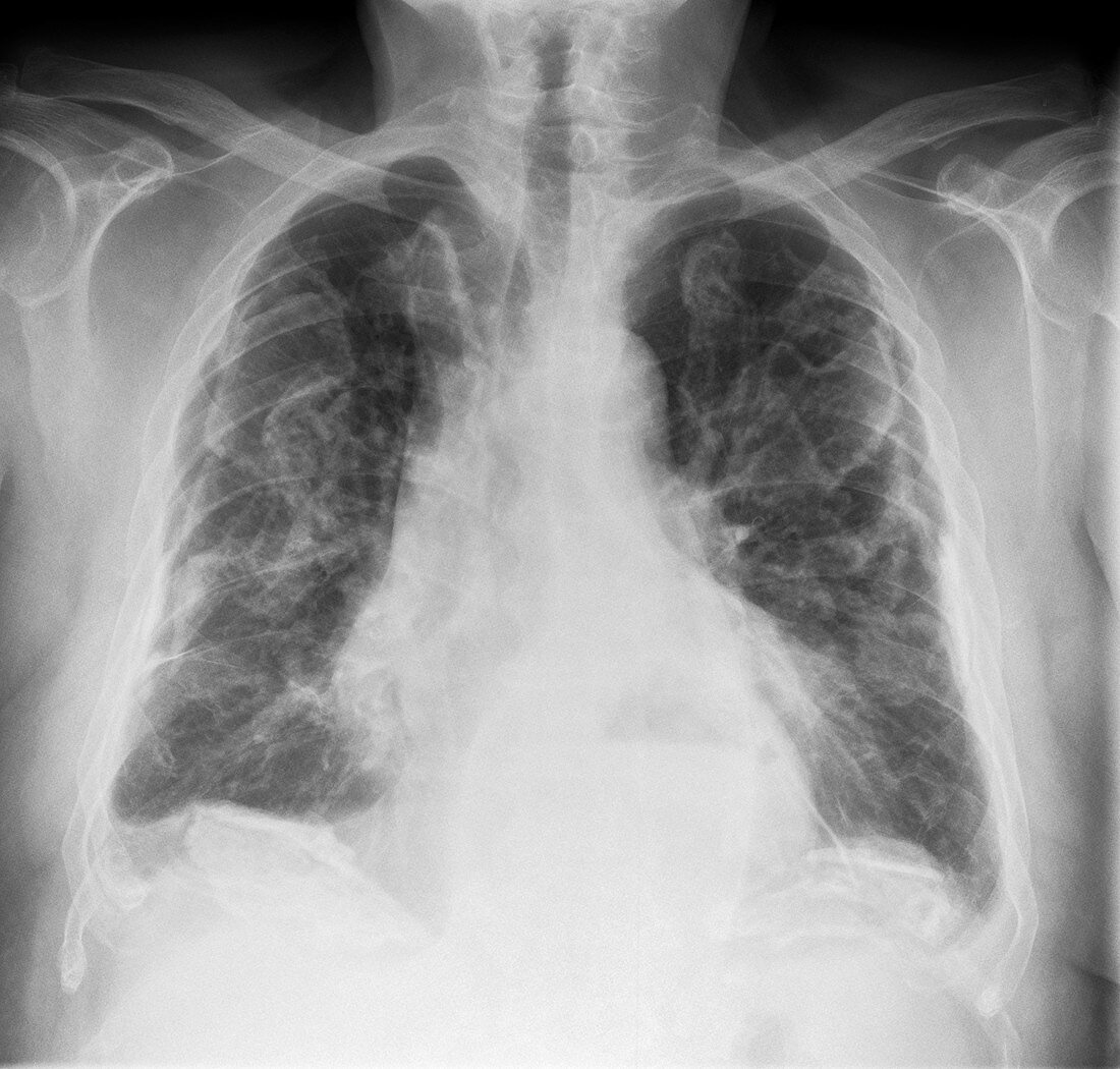 Asbestosis,X-ray