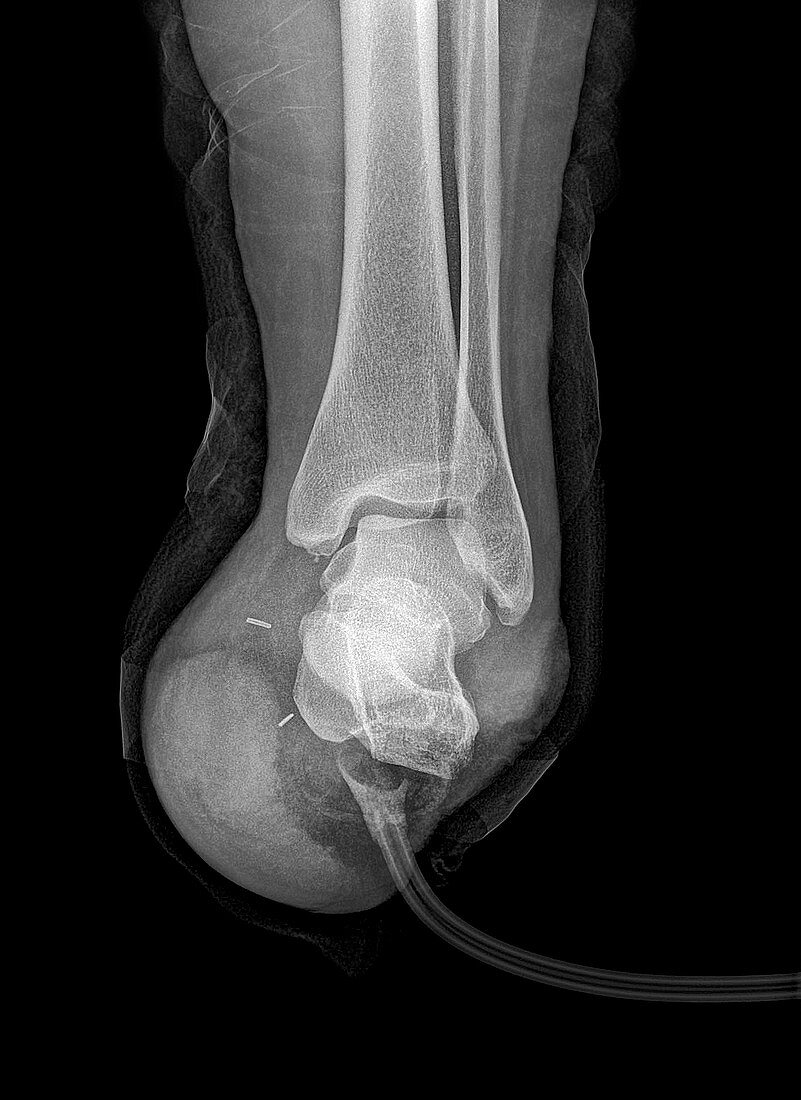 Amputated foot,X-ray
