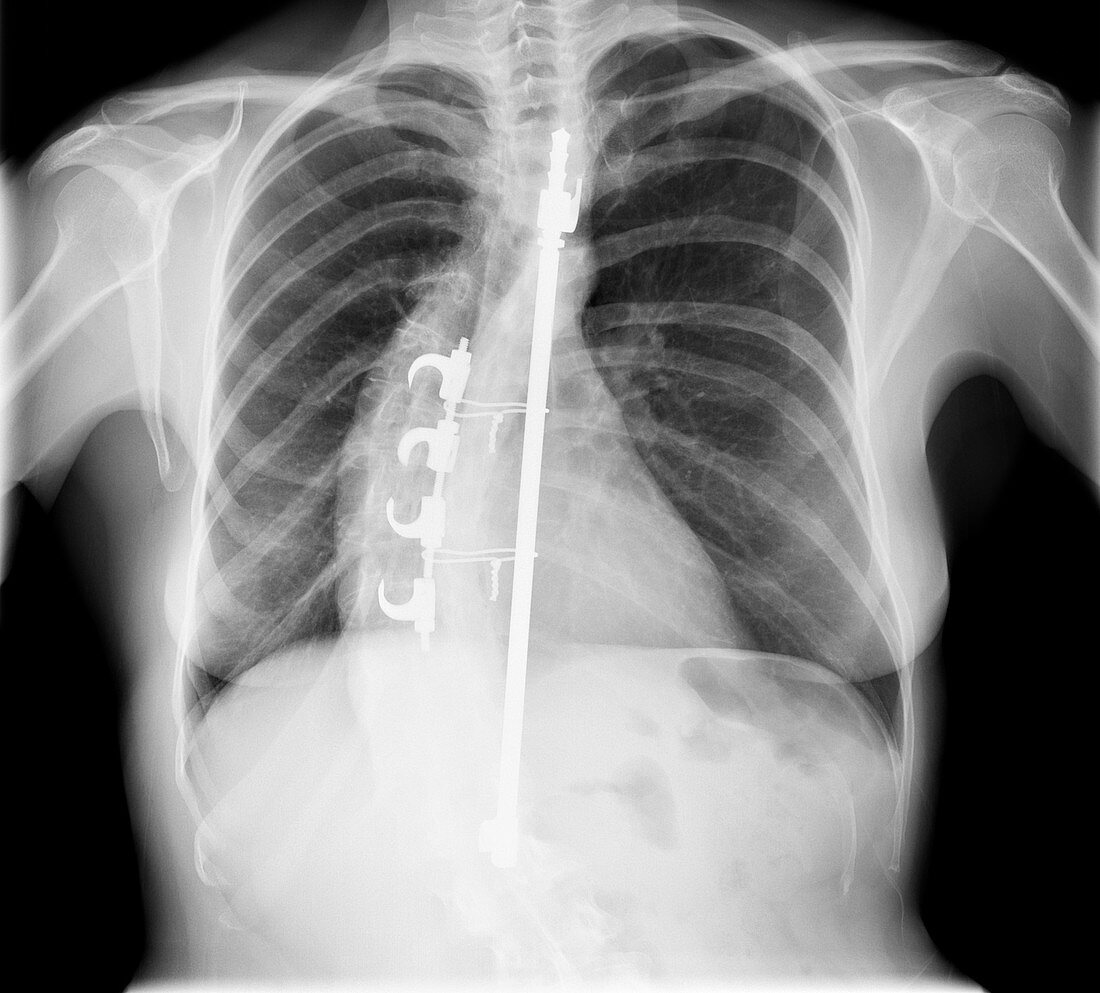 Scoliosis treatment,X-ray