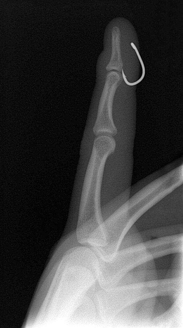 Fish hook in finger,X-ray