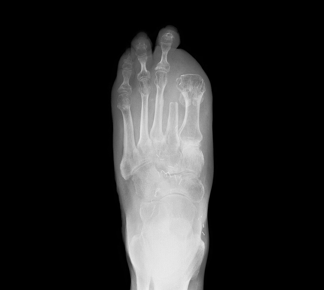 Amputated toes,X-ray