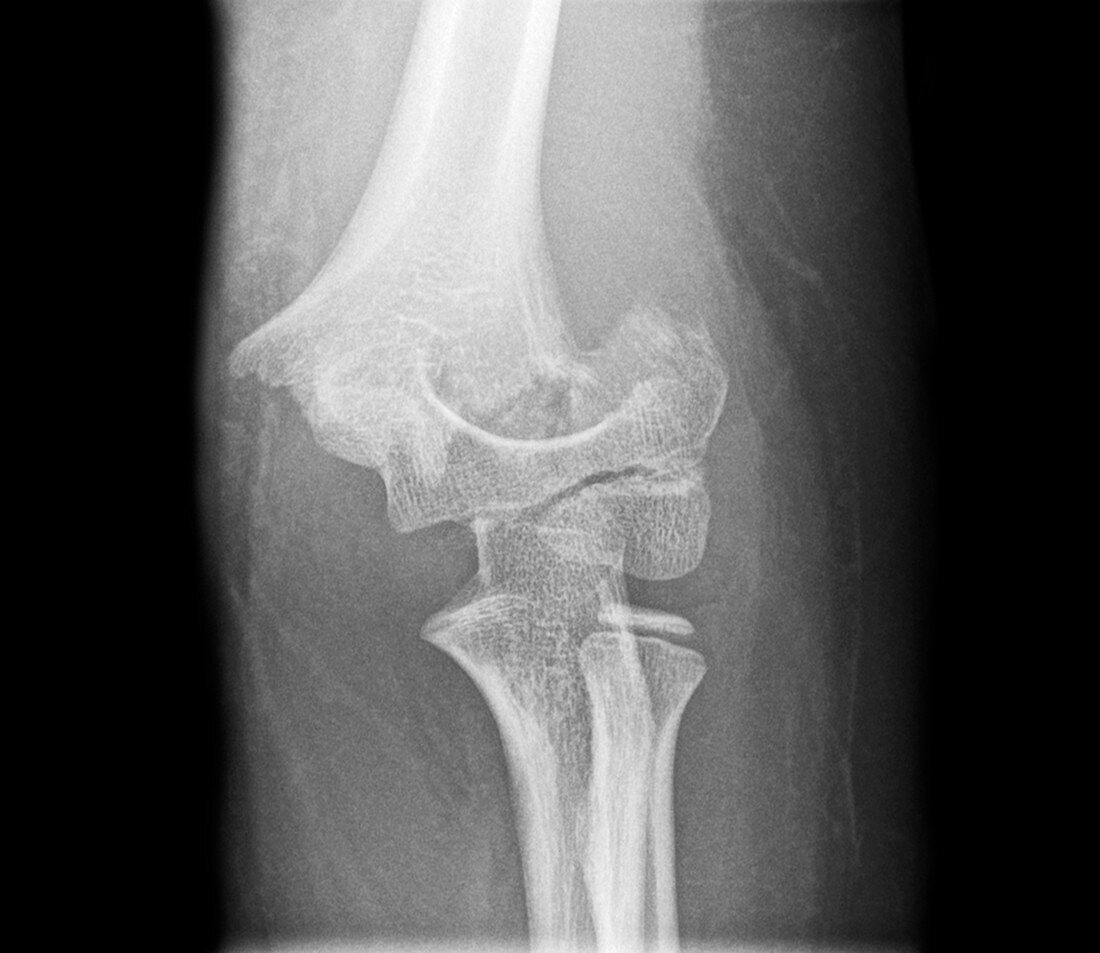 Fractured elbow,X-ray