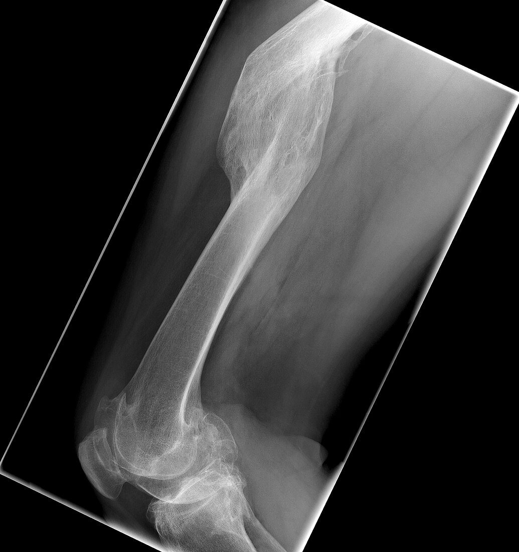 Malunited fracture,X-ray