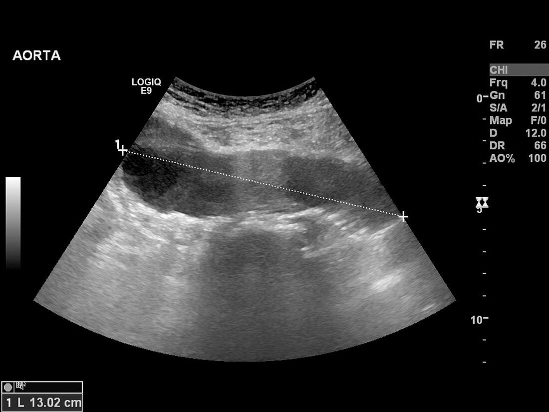 Abdominal aortic aneurysm,ultrasound