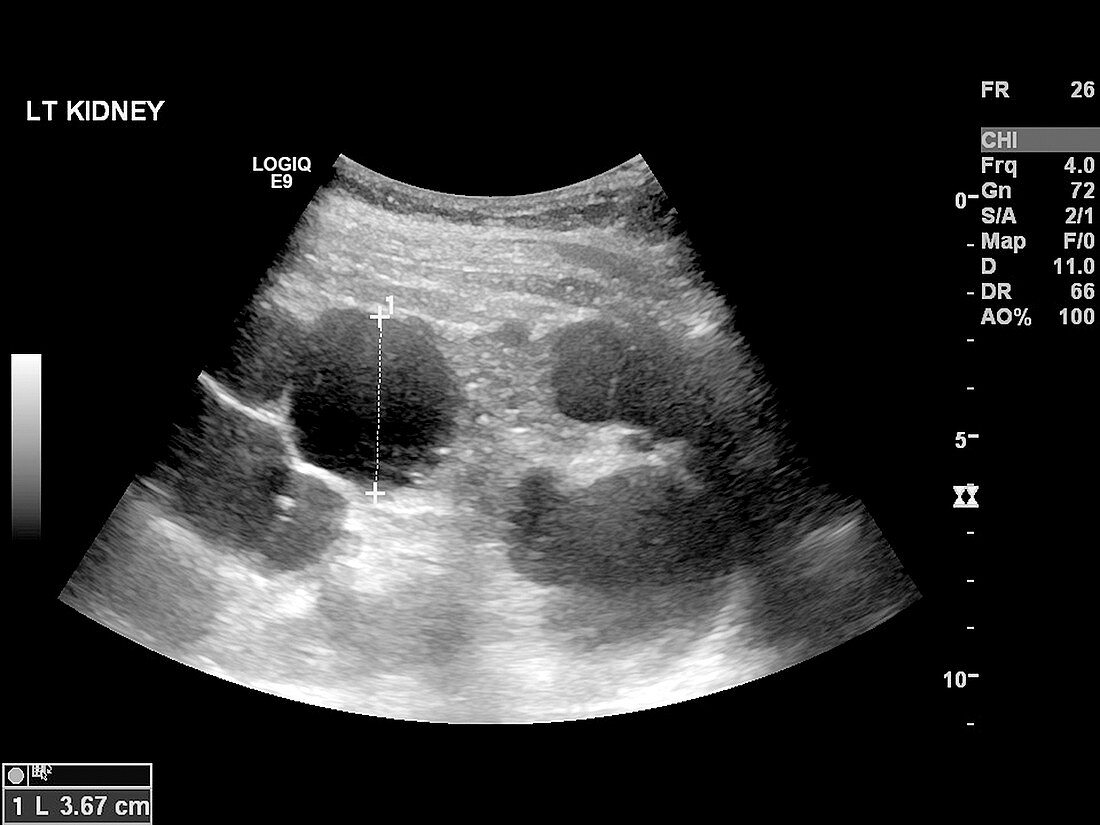 Polycystic kidney,ultrasound scan