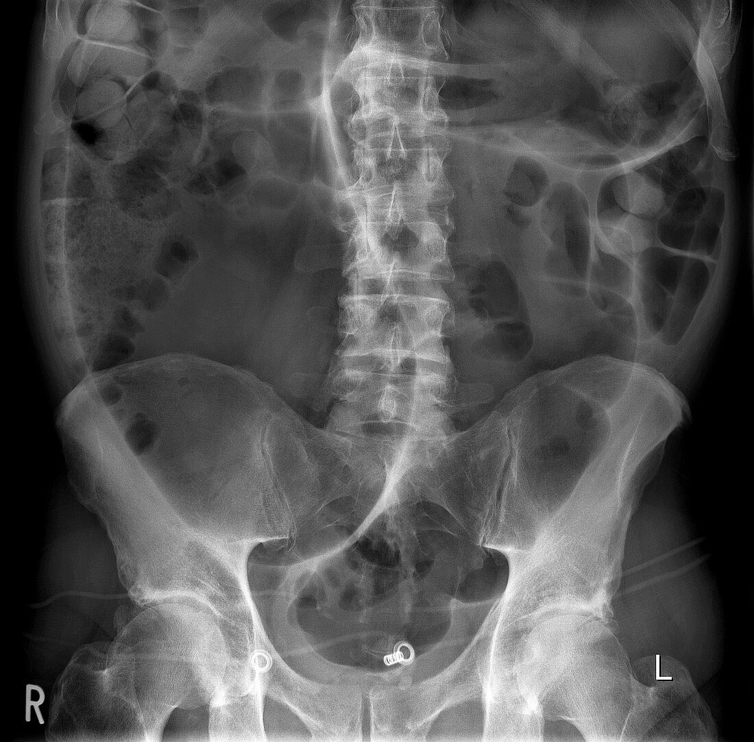 Twisted colon,X-ray