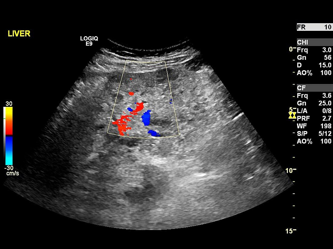 Secondary liver cancer,ultrasound scan