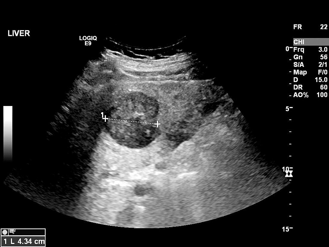 Secondary liver cancer,ultrasound scan