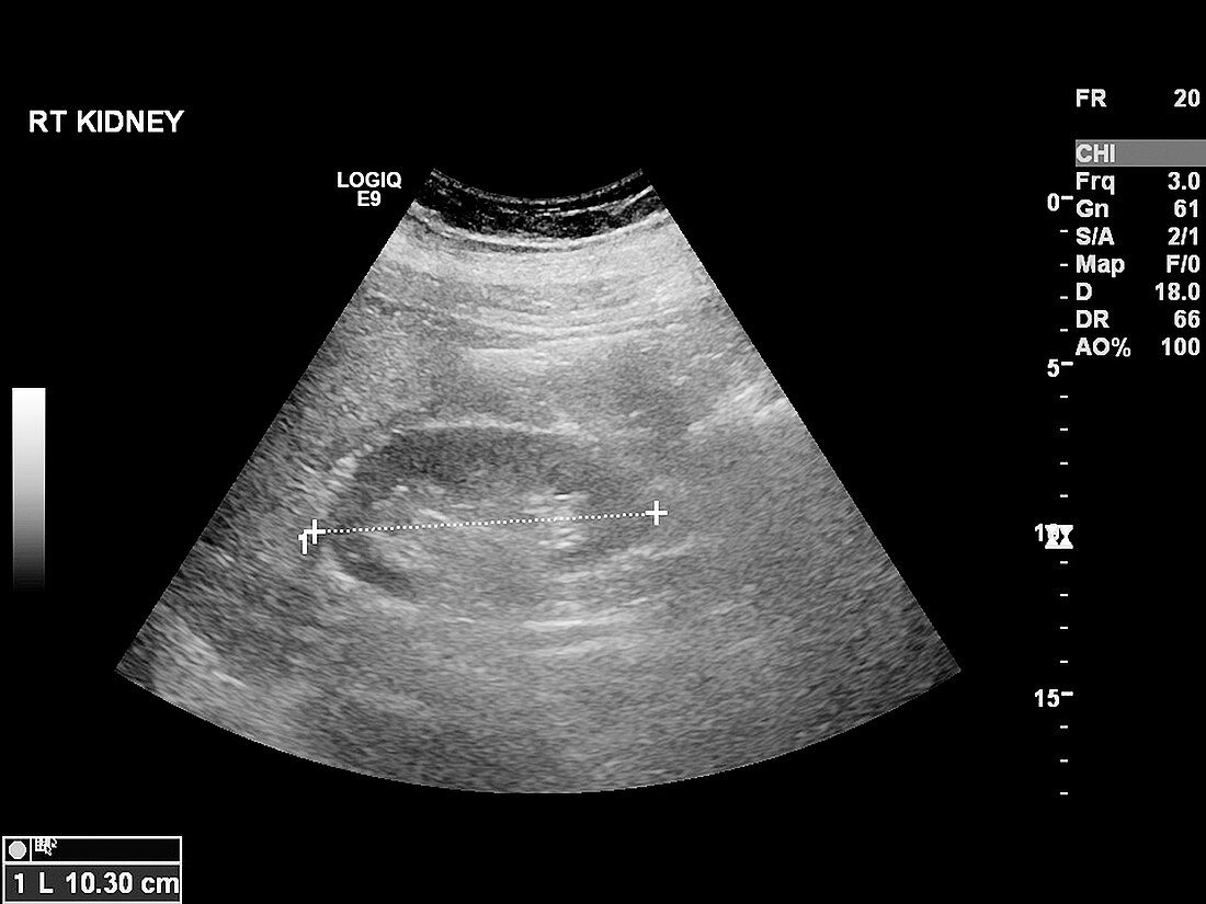 Liver mass,ultrasound scan