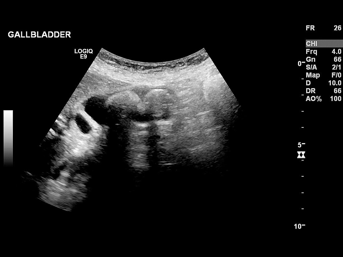 Gallstones,ultrasound scan