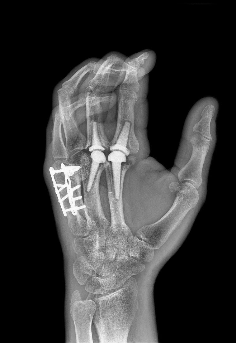 Knuckle replacement,X-ray