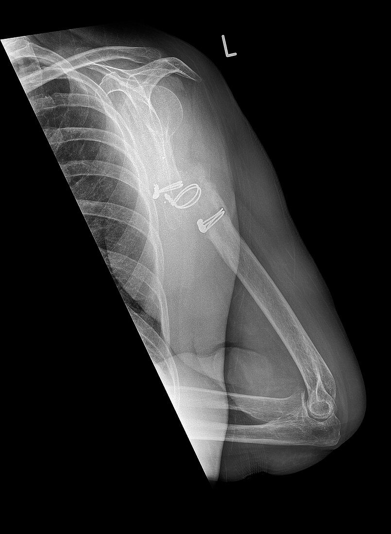 Infected malunited fracture,X-ray
