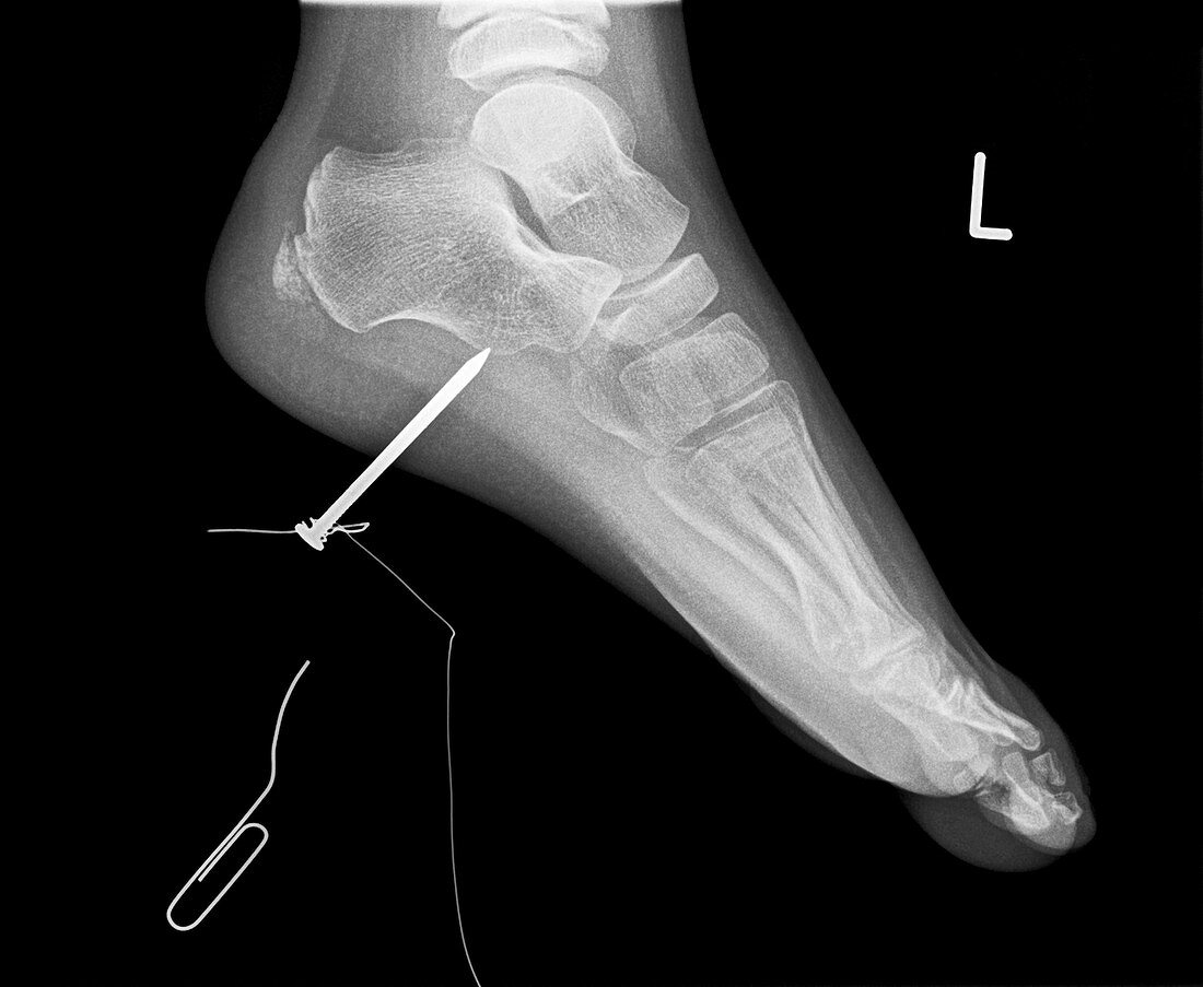 Nail in foot,X-ray