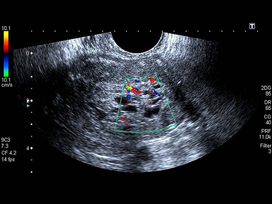 Postmenopausal bleeding,ultrasound scan