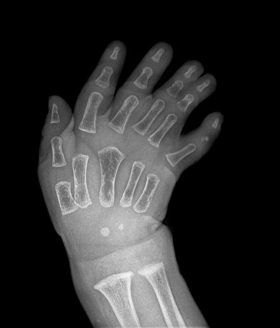 Extra fingers,X-ray