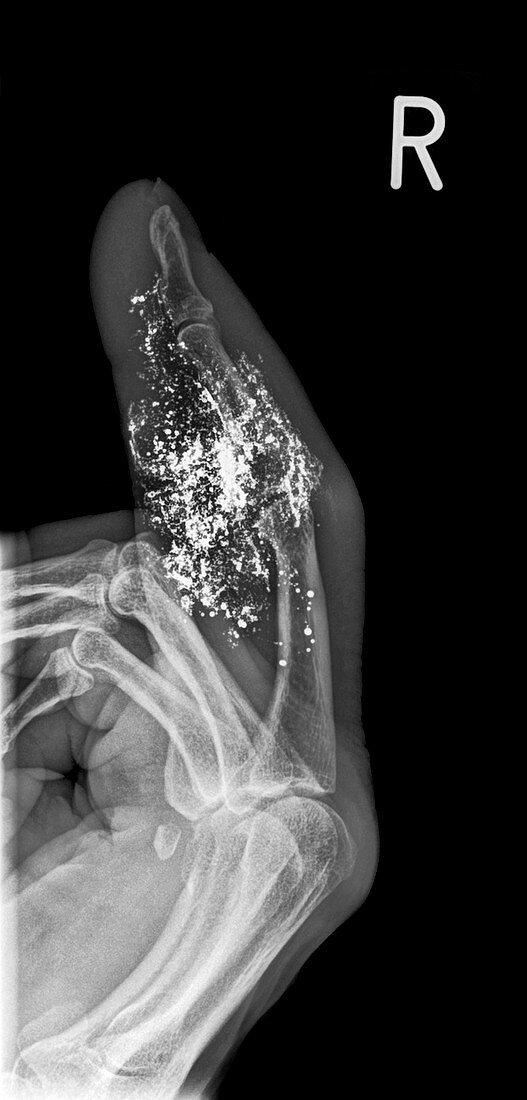 Foreign body in finger,X-ray