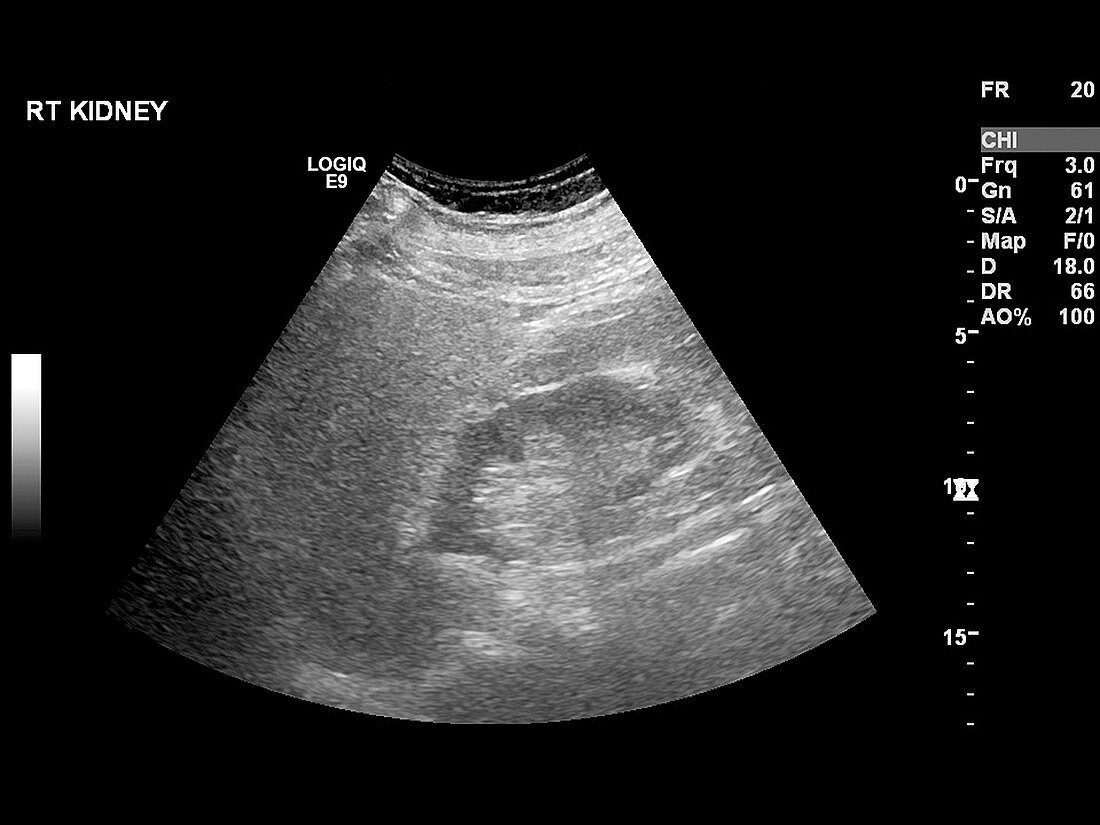 Liver mass,ultrasound scan