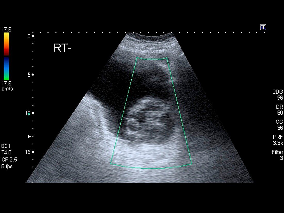 Ovarian cysts,ultrasound scan