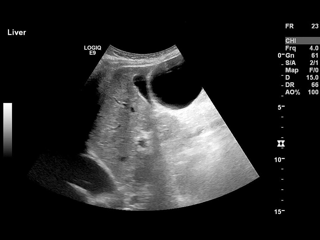 Polycystic liver disease,ultrasound scan