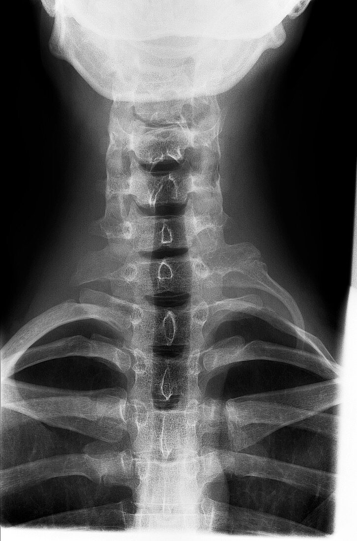 Cervical rib,X-ray