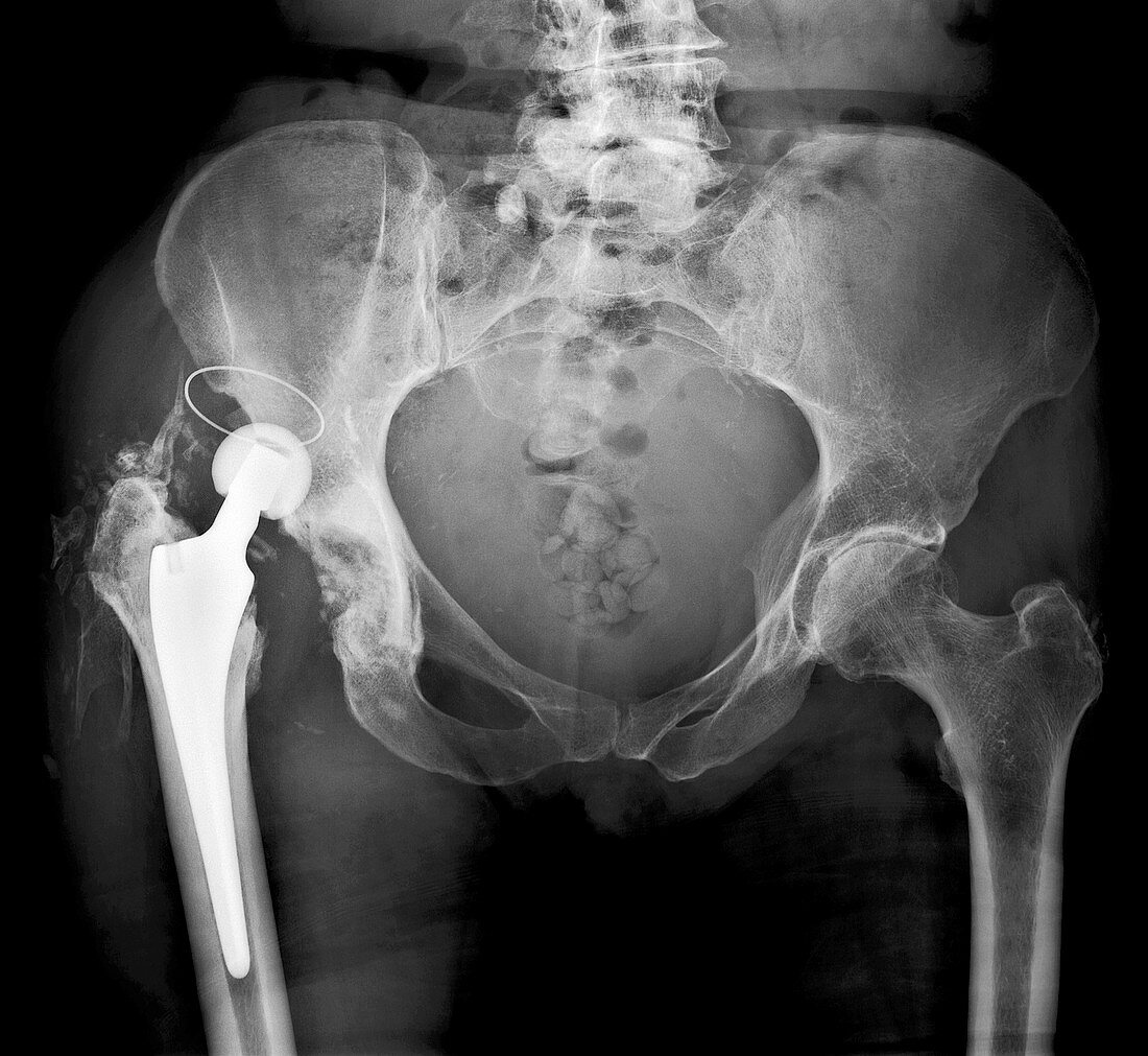 Dislocated hip replacement,X-ray