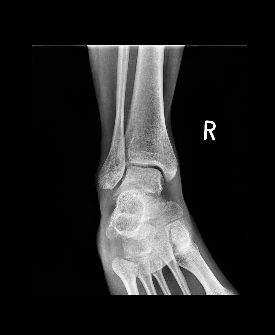 Ankle bone fracture,X-ray
