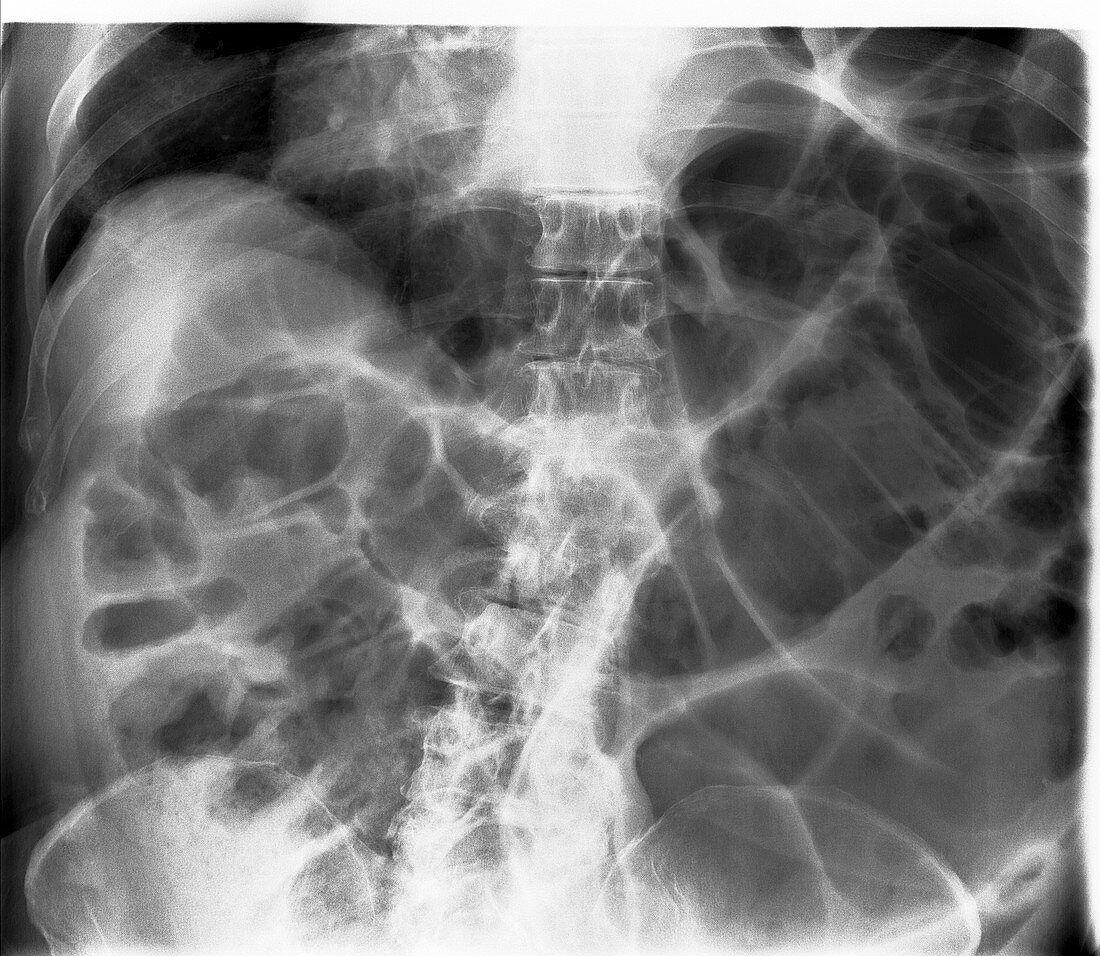 Large bowel obstruction,X-ray