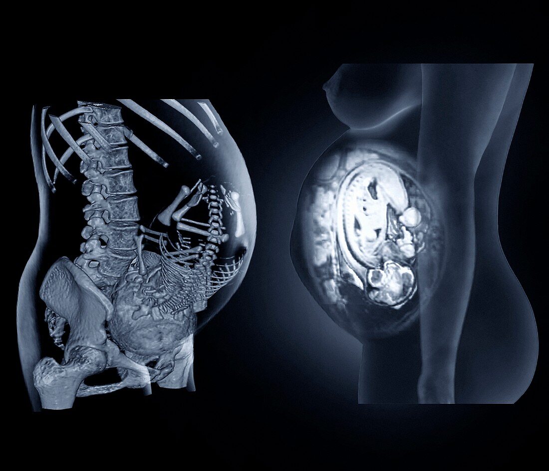 Full term foetus,CT and MRI scans