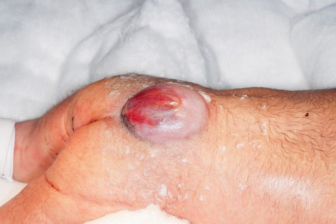 Myelomeningocele birth defect