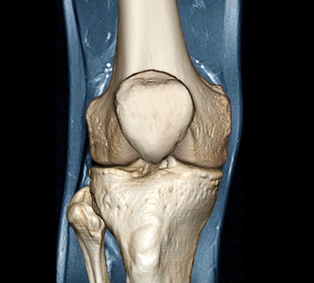 Healthy knee,CT scan