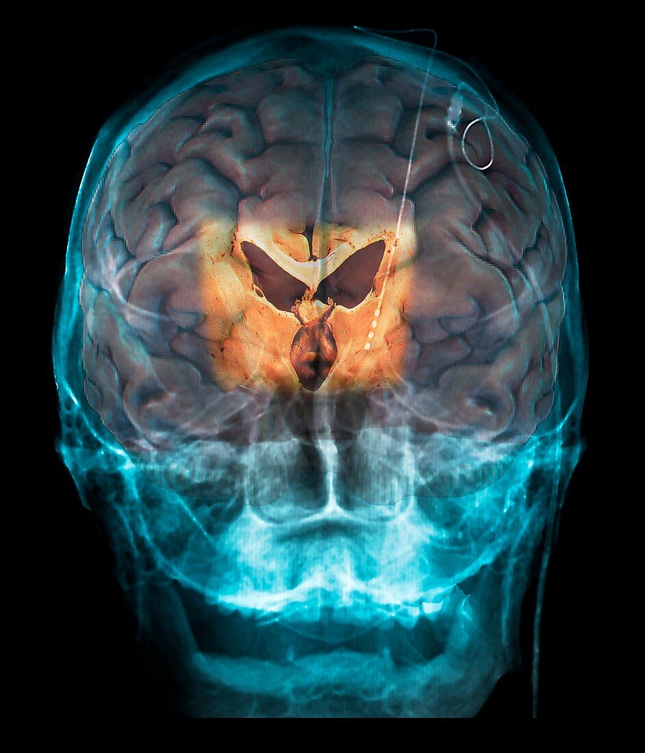 Brain implants for Parkinson's disease