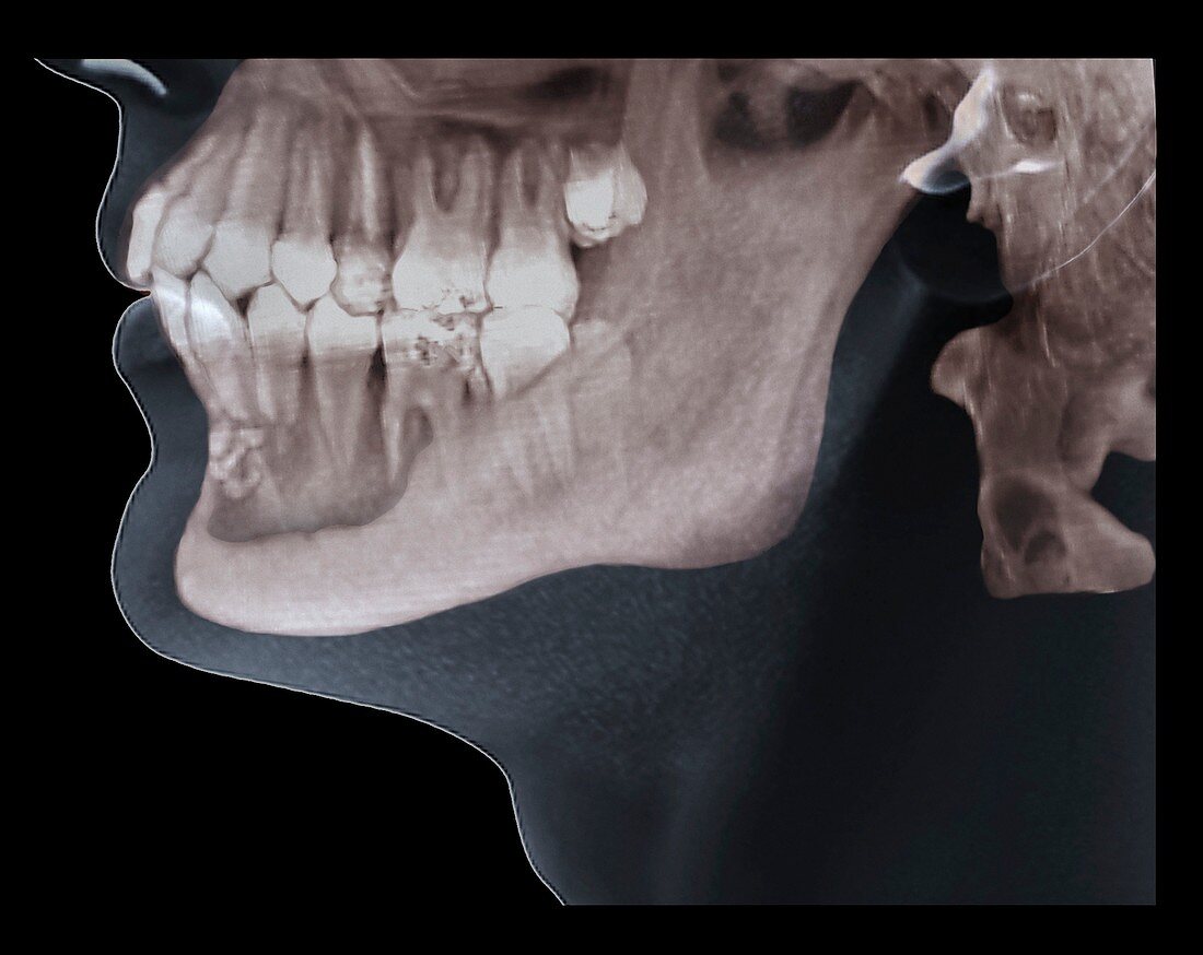 Jaw tumour,CT scan