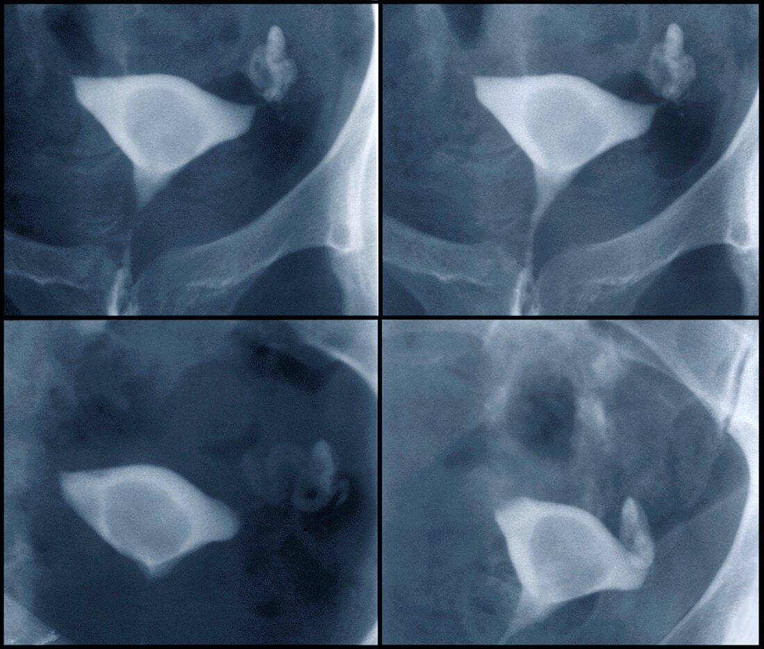 Endometrial polyp,X-rays