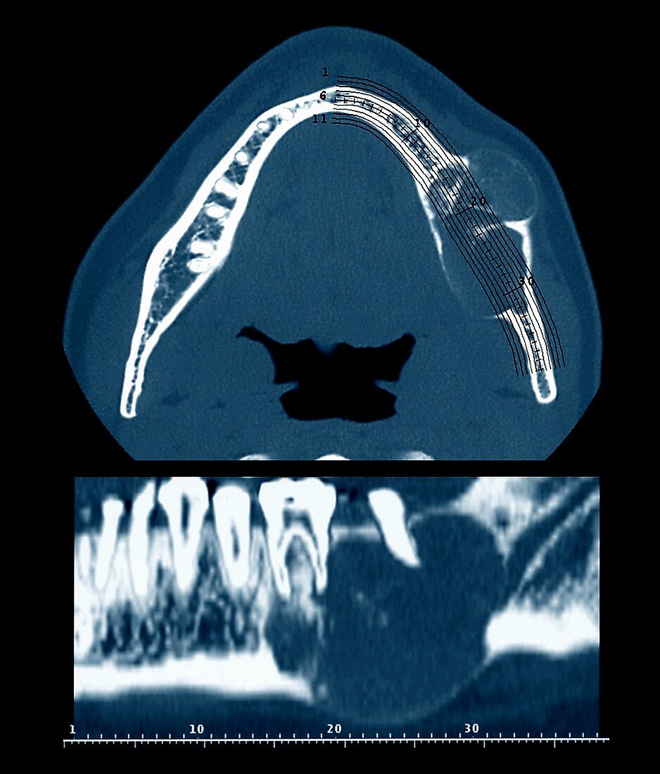 Benign dental tumour,CT scans