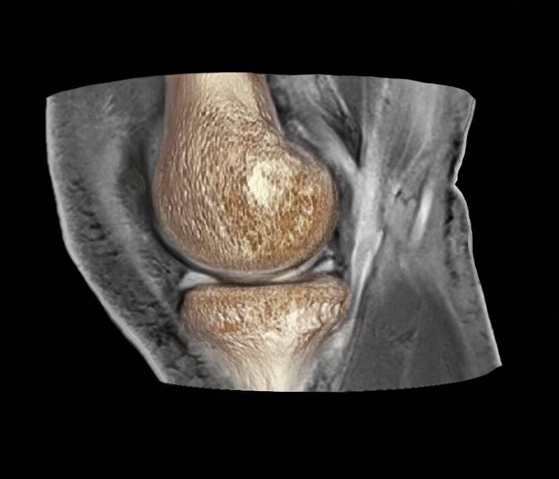 Knee injury,3D CT scan