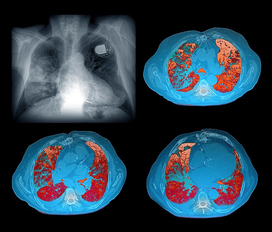 Heart and lung disease,X-rays