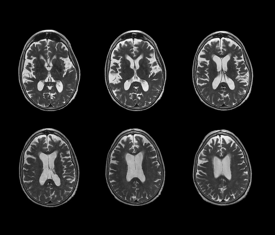 Early-onset Alzheimer's disease,MRI scan