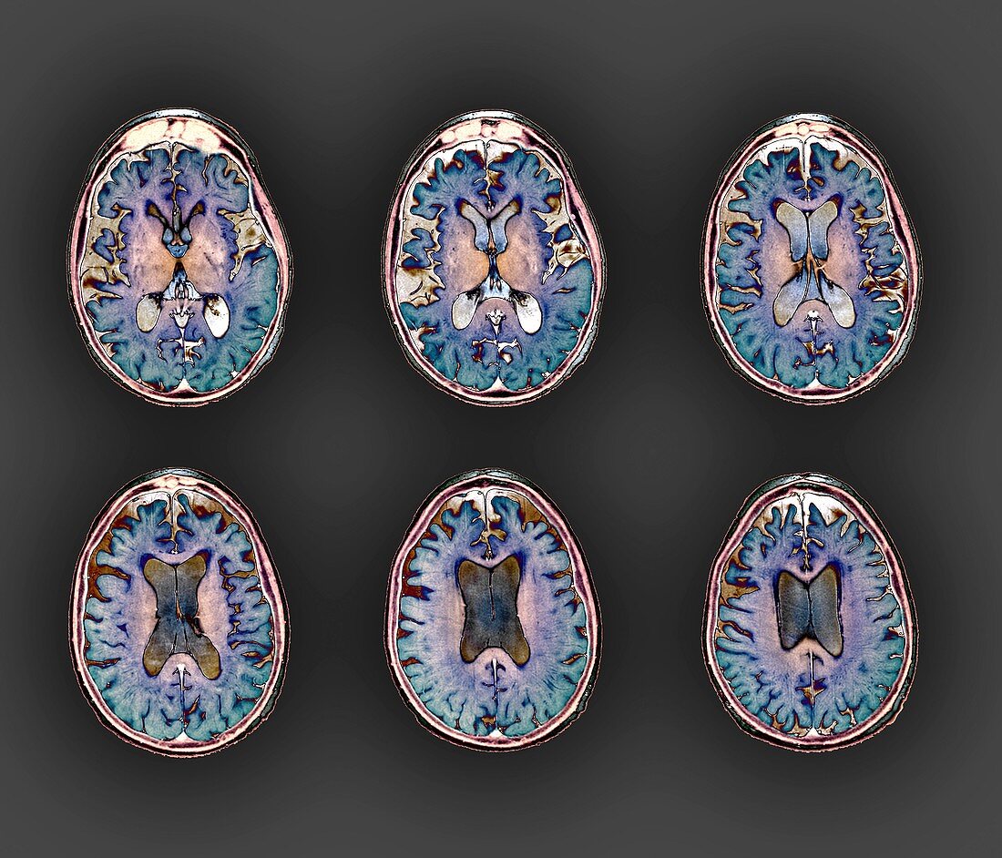 Early-onset Alzheimer's disease,MRI scan