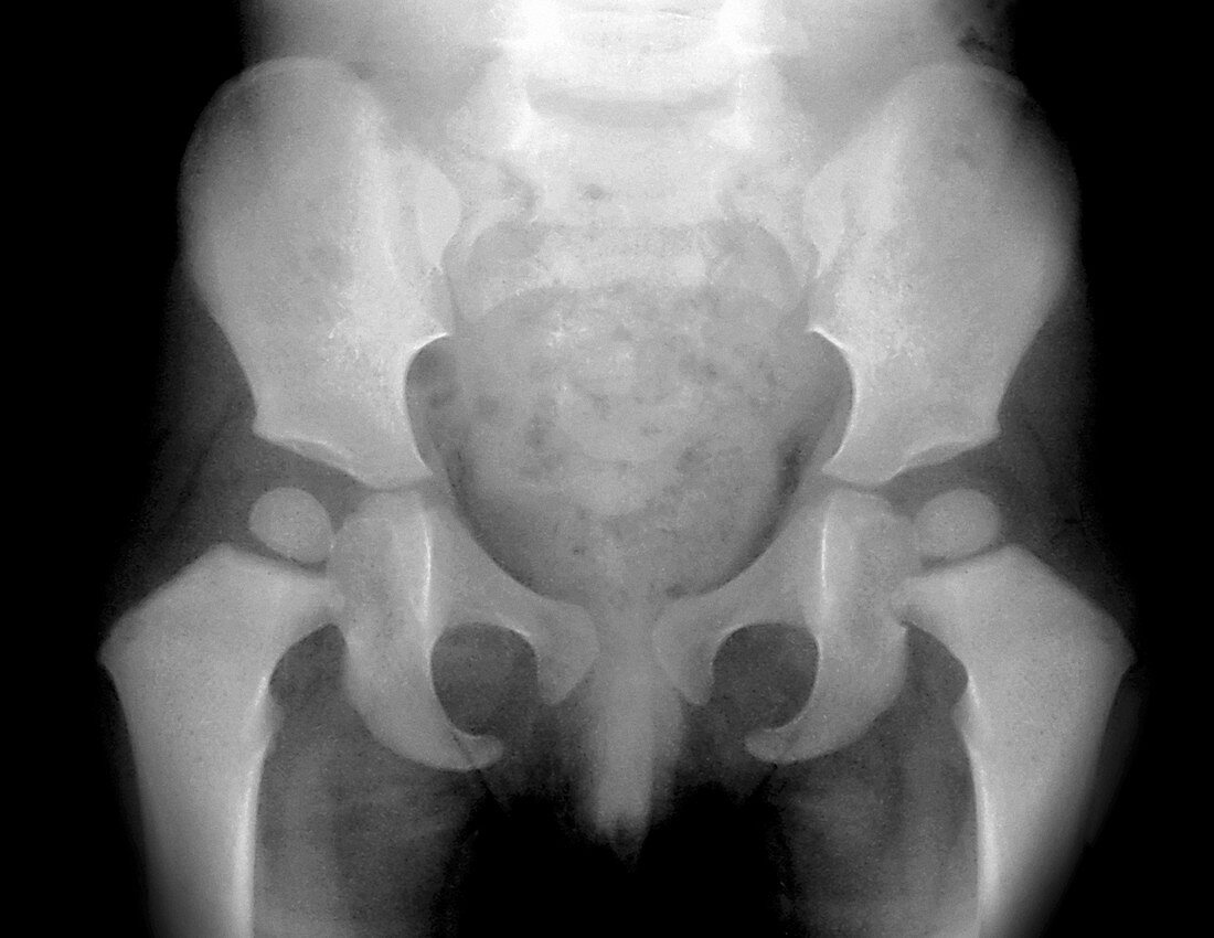 17 month old baby's pelvis,X-ray